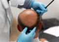 FUE Hair Transplant-The Most Efficient Way to Tackle Hair Fall