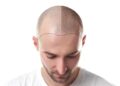Who Performs Your Scalp Micropigmentation Treatment?