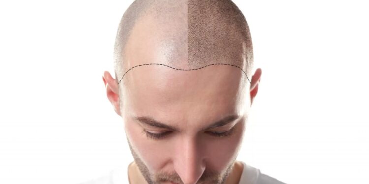 Who Performs Your Scalp Micropigmentation Treatment?